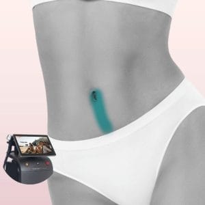 Mujer con abdomen descubierto mostrando piel suave, clara y sin vello en la línea alba tras tratamiento de depilación láser con Soprano Titanium en Clínica Vitabella Copiapó.