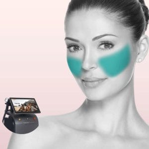 Mujer con piel suave y luminosa, sonriente, mostrando su rostro limpio y sin vello en las mejillas después de tratamiento de depilación láser con Soprano Titanium en Clínica Vitabella Copiapó.