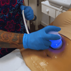 Pack Anti-Celulitis con Ultracavitación (10 sesiones)