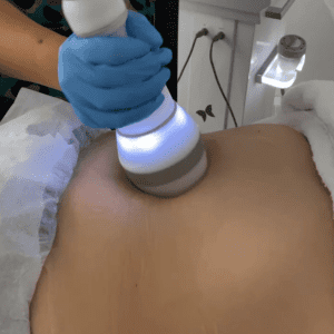 Criofrecuencia Abdomen — Reafirma tu Abdomen sin Cirugía (Pack 6 Sesiones)