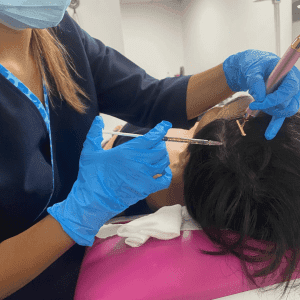 Plasma rico en plaquetas Capilar con Microneedling