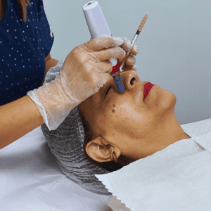 Plasma rico en plaquetas (PRP) con Microneedling - Piel radiante